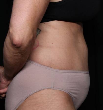 Liposuction Before & After Patient #32637