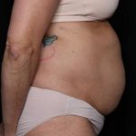 Liposuction Before & After Patient #32637