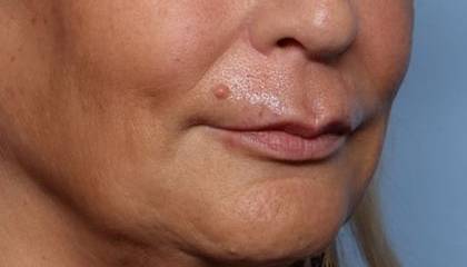 Lip Filler Before & After Patient #32666