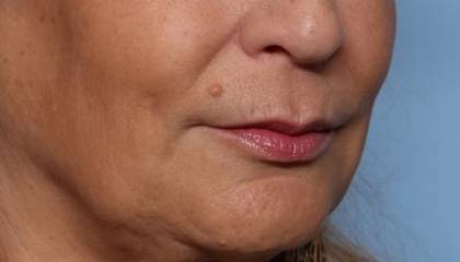 Lip Filler Before & After Patient #32666