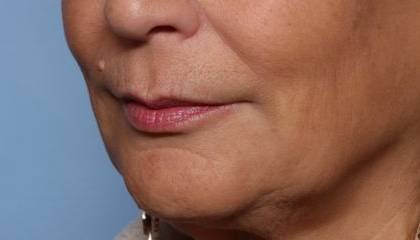 Lip Filler Before & After Patient #32666