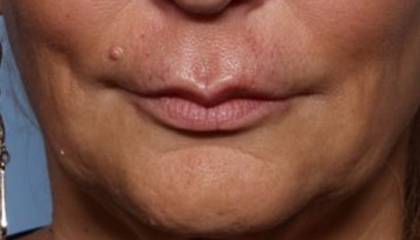 Lip Filler Before & After Patient #32666