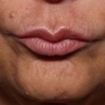 Lip Filler Before & After Patient #32666