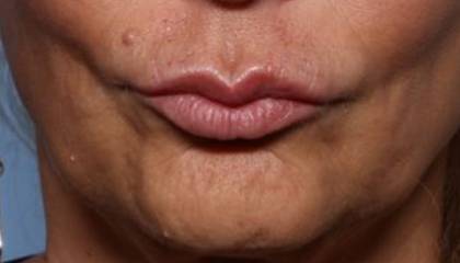 Lip Filler Before & After Patient #32666