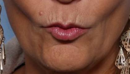 Lip Filler Before & After Patient #32666