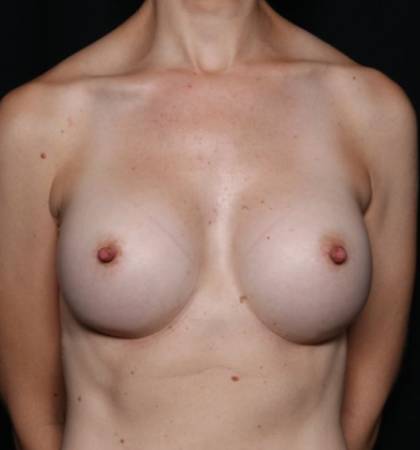 Breast Augmentation Before & After Patient #32675