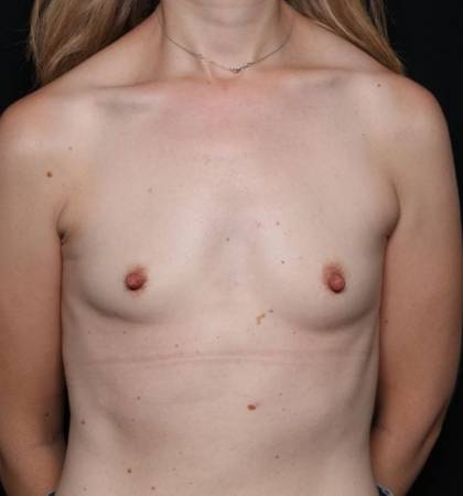 Breast Augmentation Before & After Patient #32675