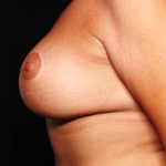 Breast Lift with Implant Before & After Patient #32709