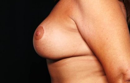 Breast Lift with Implant Before & After Patient #32709