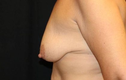 Breast Lift with Implant Before & After Patient #32709