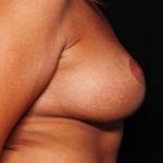 Breast Lift with Implant Before & After Patient #32709