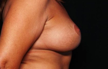 Breast Lift with Implant Before & After Patient #32709