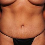 Tummy Tuck Before & After Patient #32731