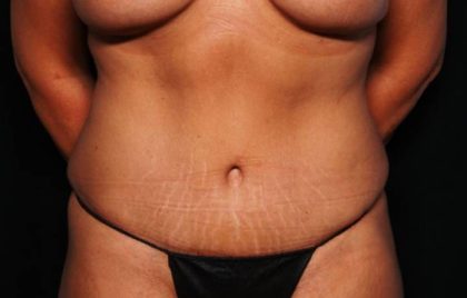 Tummy Tuck Before & After Patient #32731