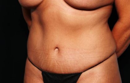 Tummy Tuck Before & After Patient #32731