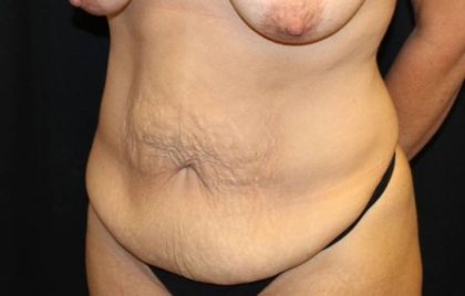 Tummy Tuck Before & After Patient #32731