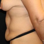 Tummy Tuck Before & After Patient #32731