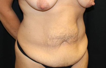 Tummy Tuck Before & After Patient #32731