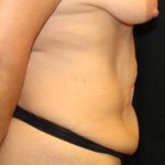 Tummy Tuck Before & After Patient #32731