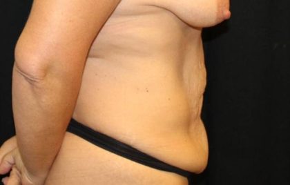 Tummy Tuck Before & After Patient #32731