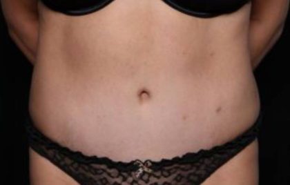 Liposuction Before & After Patient #32753