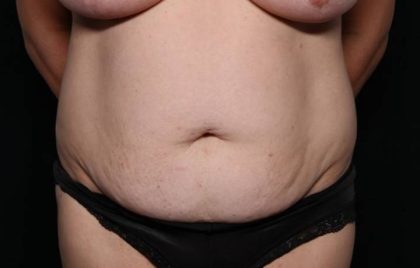 Liposuction Before & After Patient #32753