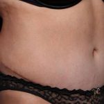 Liposuction Before & After Patient #32753