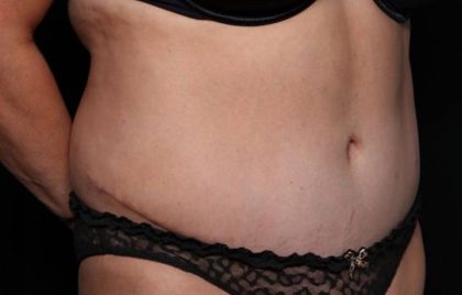 Liposuction Before & After Patient #32753