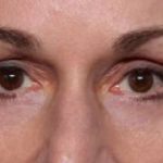 Blepharoplasty and Brow Lift Before & After Patient #32754