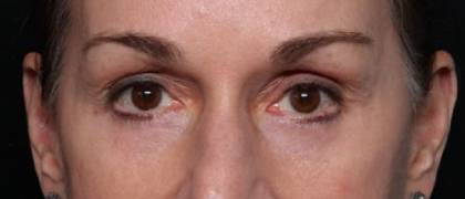 Blepharoplasty and Brow Lift Before & After Patient #32754