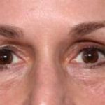 Blepharoplasty and Brow Lift Before & After Patient #32754