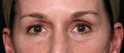 Blepharoplasty and Brow Lift Before & After Patient #32754