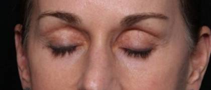 Blepharoplasty and Brow Lift Before & After Patient #32754