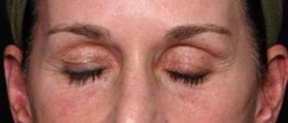 Blepharoplasty and Brow Lift Before & After Patient #32754