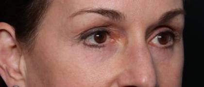 Blepharoplasty and Brow Lift Before & After Patient #32754