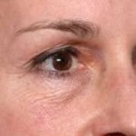 Blepharoplasty and Brow Lift Before & After Patient #32754