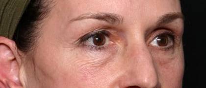 Blepharoplasty and Brow Lift Before & After Patient #32754