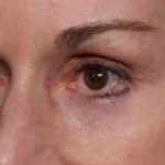 Blepharoplasty and Brow Lift Before & After Patient #32754