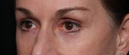 Blepharoplasty and Brow Lift Before & After Patient #32754