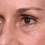 Blepharoplasty and Brow Lift Before & After Patient #32754