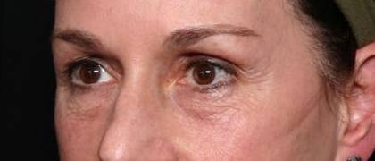 Blepharoplasty and Brow Lift Before & After Patient #32754