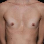 Breast Augmentation Before & After Patient #32776