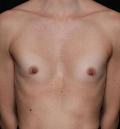 Breast Augmentation Morristown