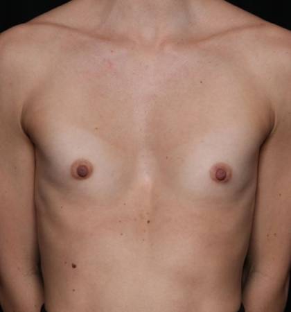 Breast Augmentation Before & After Patient #32776