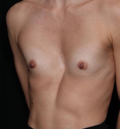 Breast Augmentation Before & After Patient #32776