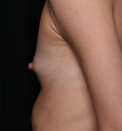 Breast Augmentation Before & After Patient #32776