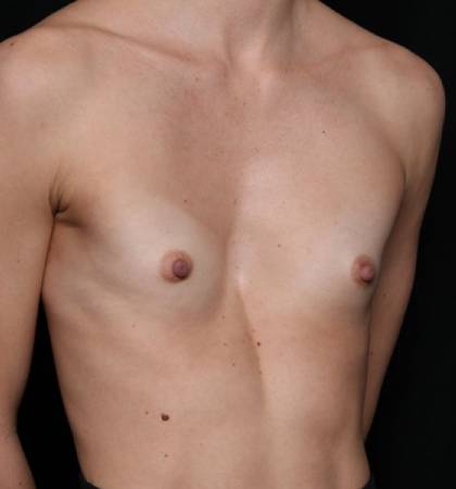 Breast Augmentation Before & After Patient #32776