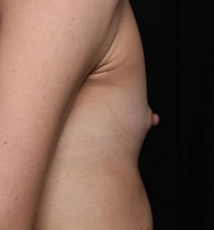 Breast Augmentation Before & After Patient #32776