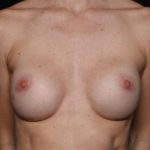 Breast Augmentation - Round Silicone Implants Before & After Patient #32594