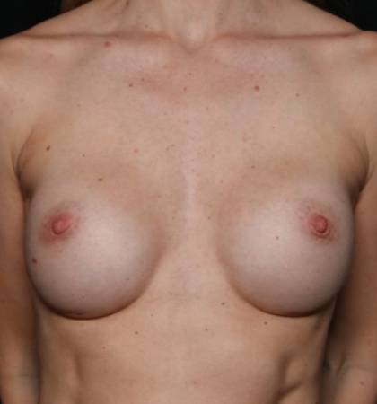 Breast Augmentation - Round Silicone Implants Before & After Patient #32594